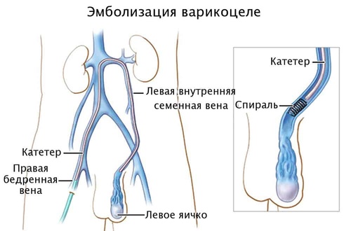 Фото: Эмболизация варикоцеле