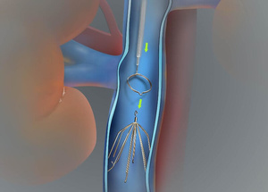 Фото:варикоцеле что это
