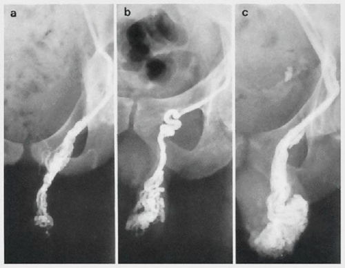 Фото: Степени тяжести варикоцеле