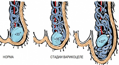 Фото: Классификация и степени варикоцеле у подростков