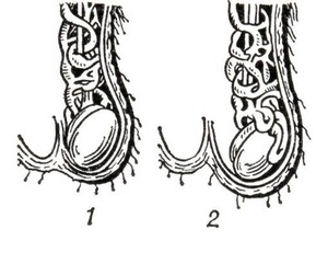 Фото: Переход варикоцеле от 1 ко 2 степени