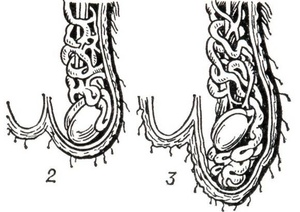 Фото: Переход варикоцеле от 2 к 3 степени