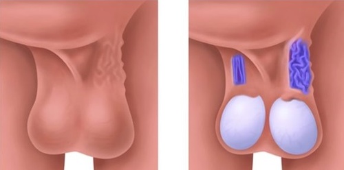 Фото: Варикоцеле 4 степени