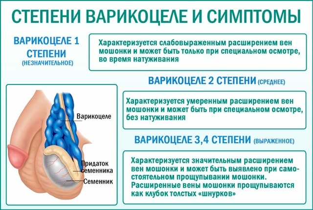 Фото: Симптомы арикоцеле
